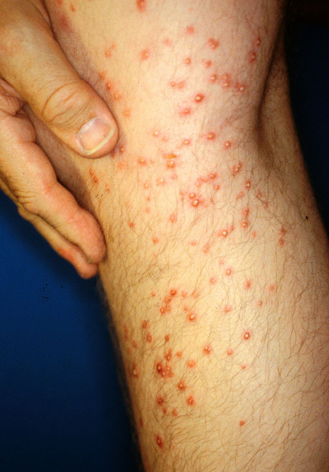 Sterile pustules following a fire ant sting.