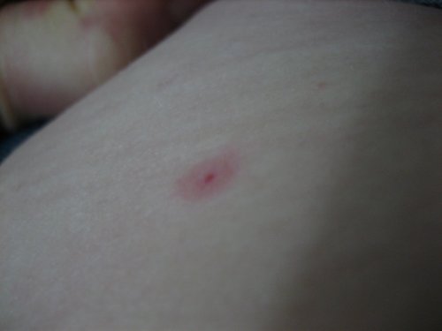Flea bite with a hemorrhagic center and surrounding erythema.