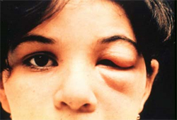 Romana’s sign, a chagoma found over the eyelid, is a marker of acute Chagas disease infection
