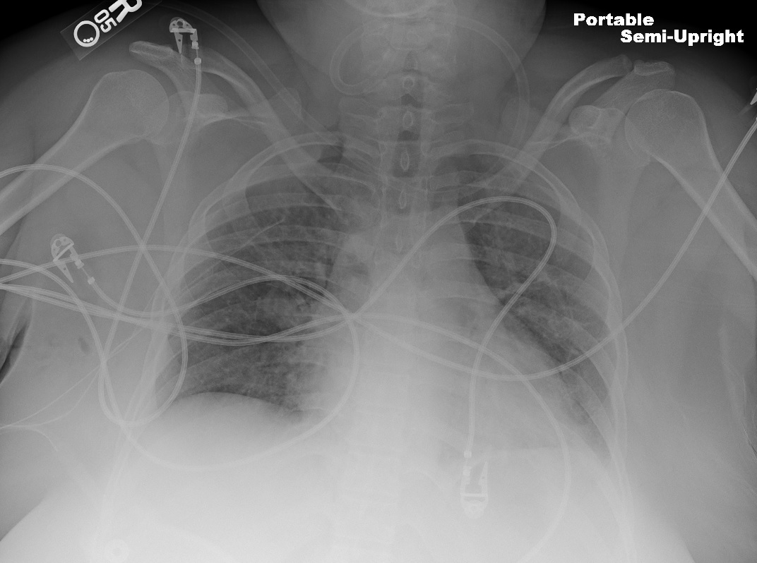 Patient with bilateral first rib resection
