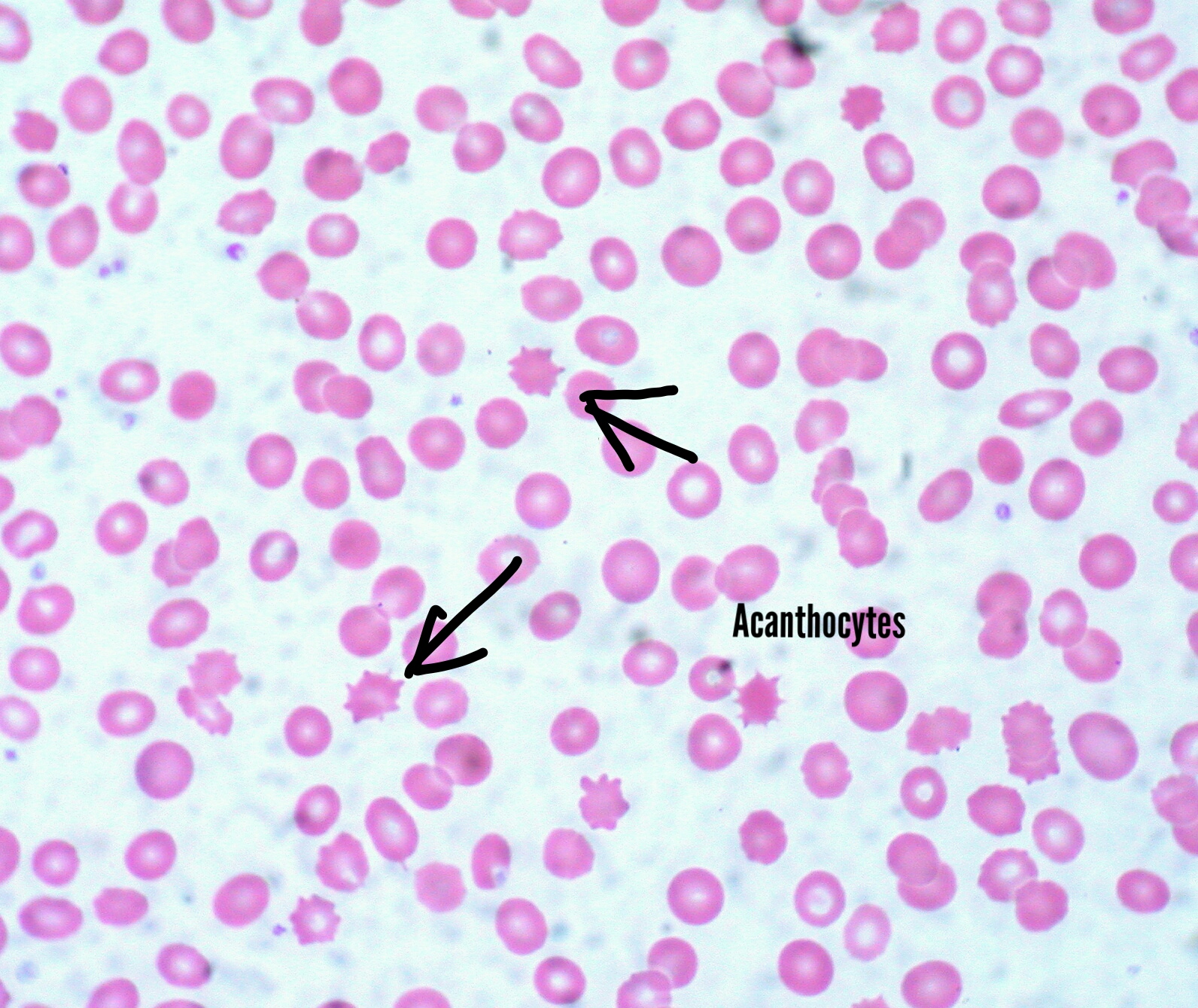 Acanthocytes found in the peripheral blood smear of abetalolipoproteinemia patients.