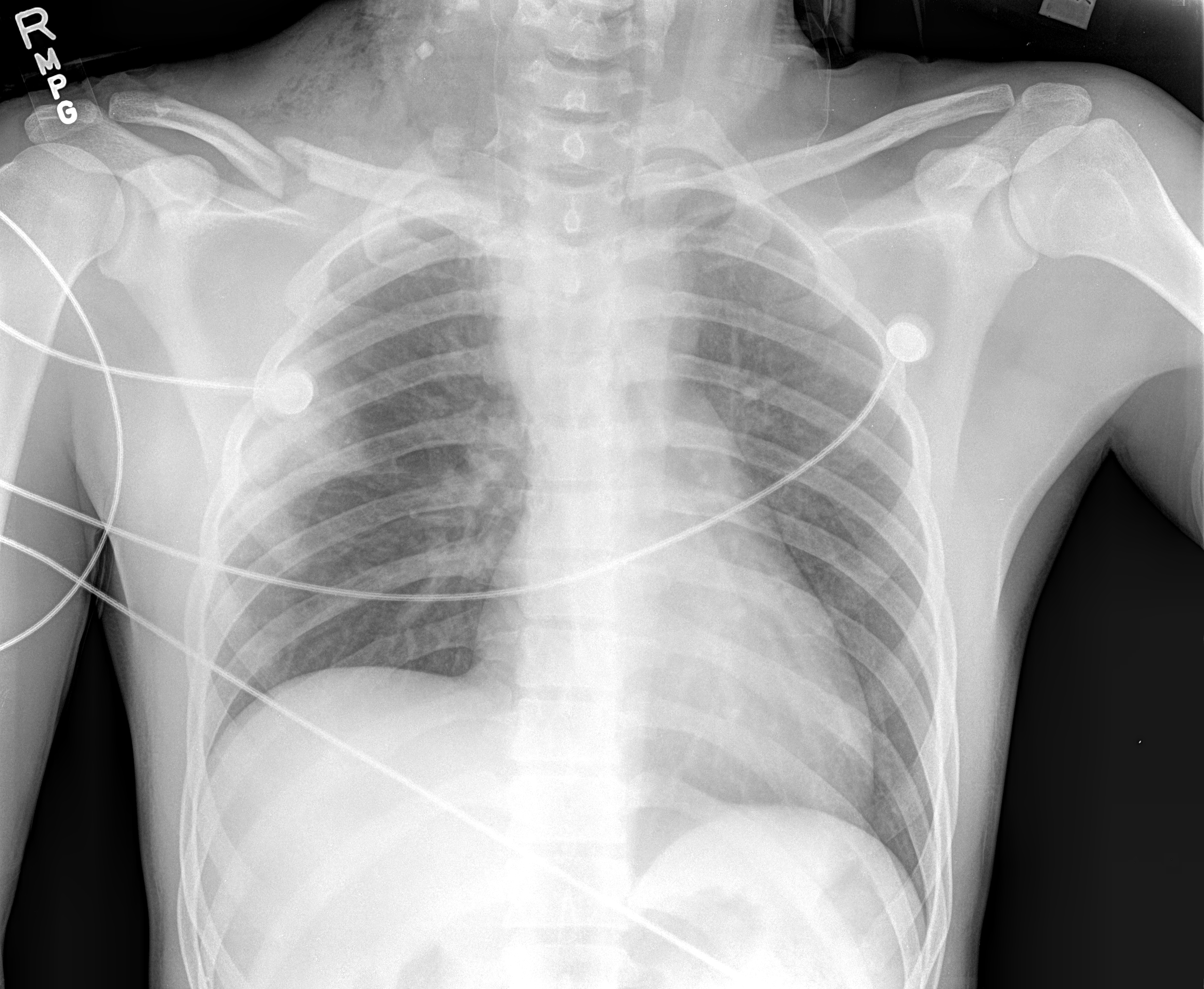 Chest x-ray of a patient who sustained traumatic root avulsion brachial plexus injury. Note the elevated right hemidiaphragm indicating associated phrenic nerve injury. The patient also sustained fractures to the right midshaft clavicle and right 1st and 2nd ribs.