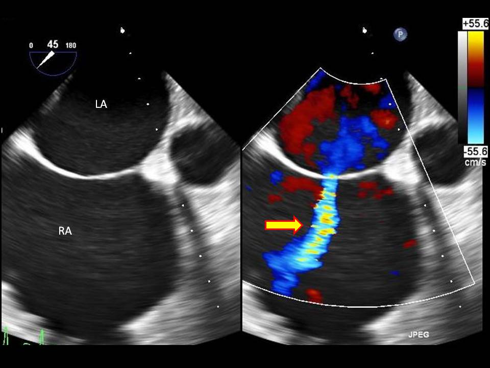 Transesophageal echocardiography image showing the presence of a secundum atrial septal defect with color Doppler left to right shunt flow (arrow) across the interatrial septum between the left atrium (LA) and right atrium (RA).
