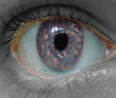 lisch nodules in the eye