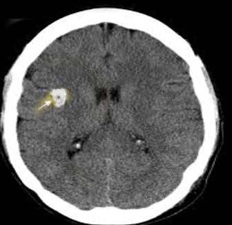 cysticercosis CT scan brain