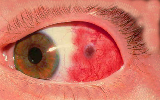 episcleritis of the eye
