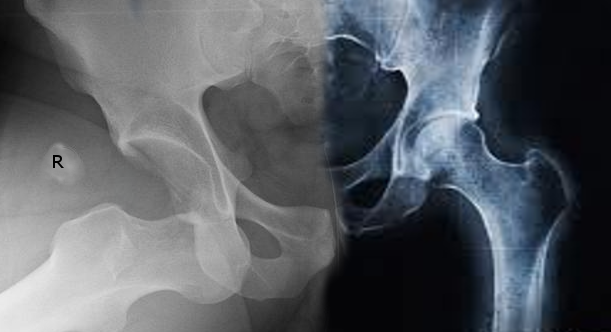 anterior hip dislocation