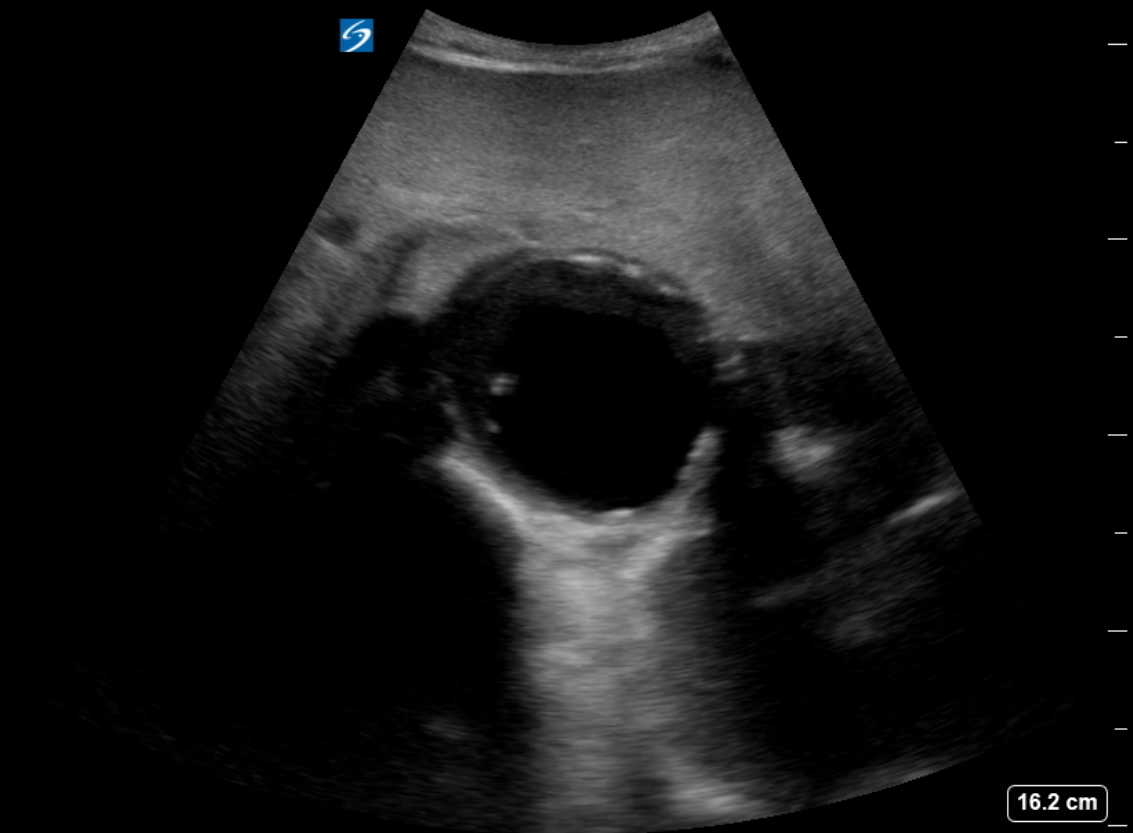 <p>Abdominal Aortic Aneurysm Ultrasound.</p>