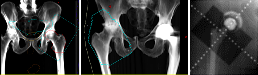 Digitally reconstructed radiographs (DRR) based on original portal images showing fields of three patients receiving radiation for heterotopic ossification of the hip. The blue line represents the field edge in the first two images. Take note that the surfaces of the greater trochanter to ilium and the lesser trochanter to the ischium are not blocked out since this is the most common location for HO formation. The third image shows shielding of the acetabular cup to prevent bony ingrowth and prosthesis failure.