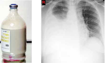 Chest x-ray chylothorax