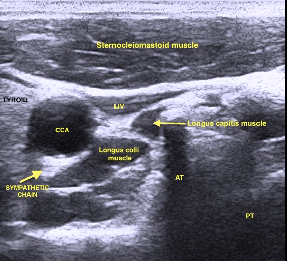 Sonographic visualisation of sympathetic chain at C6 vertebral level. You can appreciate posterior (PT) and anterior (AT) tubercle of C6 transverse process. You can see also carotid artery (CCA) and internal jugular vein (IJV) partially compressed by probe pressure. Muscles and tyroid and muscles position is clearly evidenced.