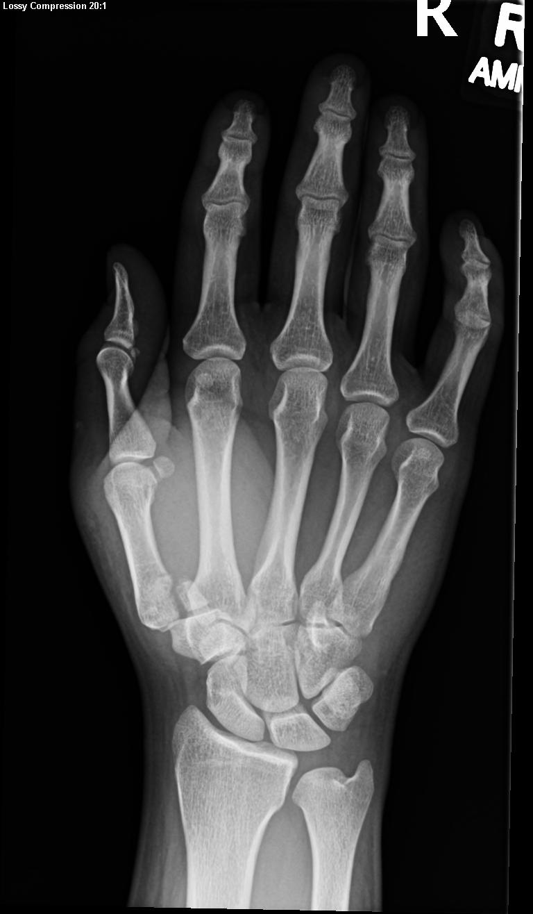 Frontal view of hand with a Bennett fracture