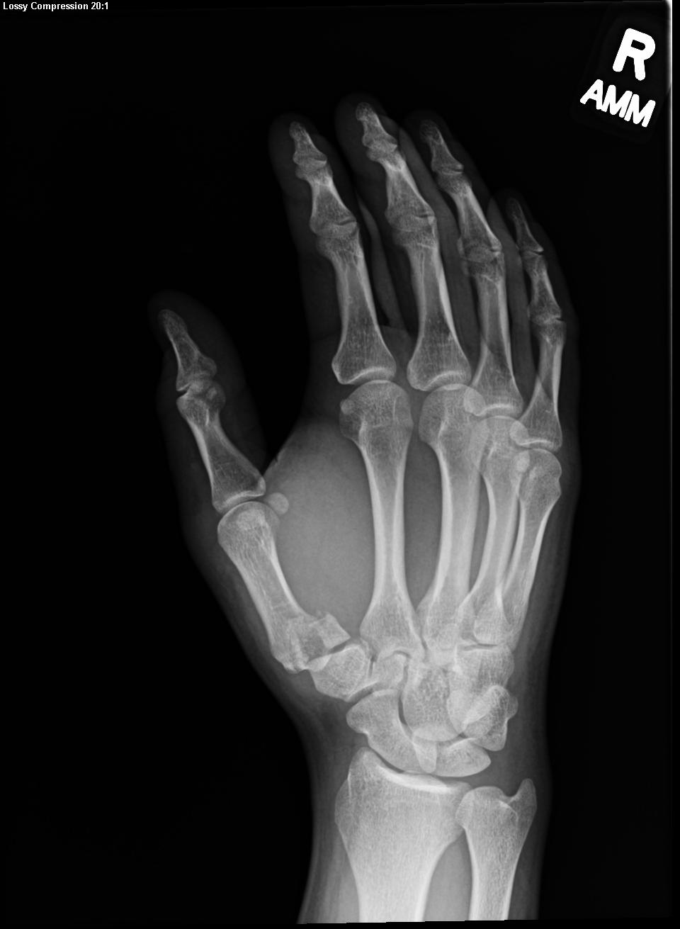 Oblique x-ray view of the hand with a Bennett fracture