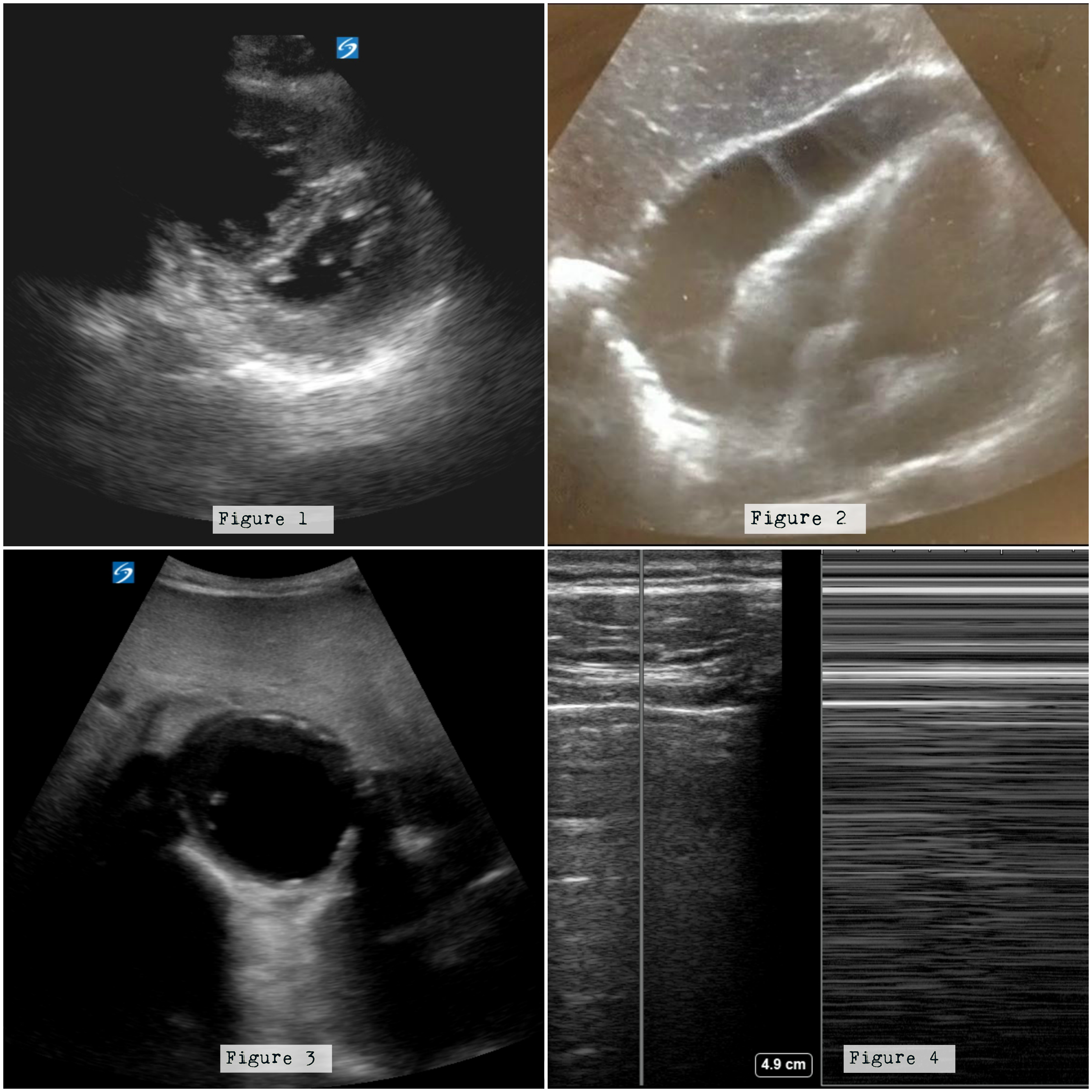 Figure 1: Note the enlarged right ventricle displacing the septum into the left ventricle. Figure 2: There is a large effusion surrounding the four chambers of the heart. Figure 3: Note the enlarged aorta. Figure 4: Note the barcode sign on the right when M mode is used between a rib interspace.