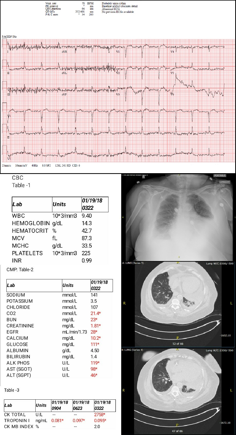 Case Study of 60 year old female presenting with Shortness of Breath