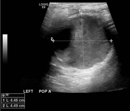 Ultrasound of left popliteal artery aneurysm