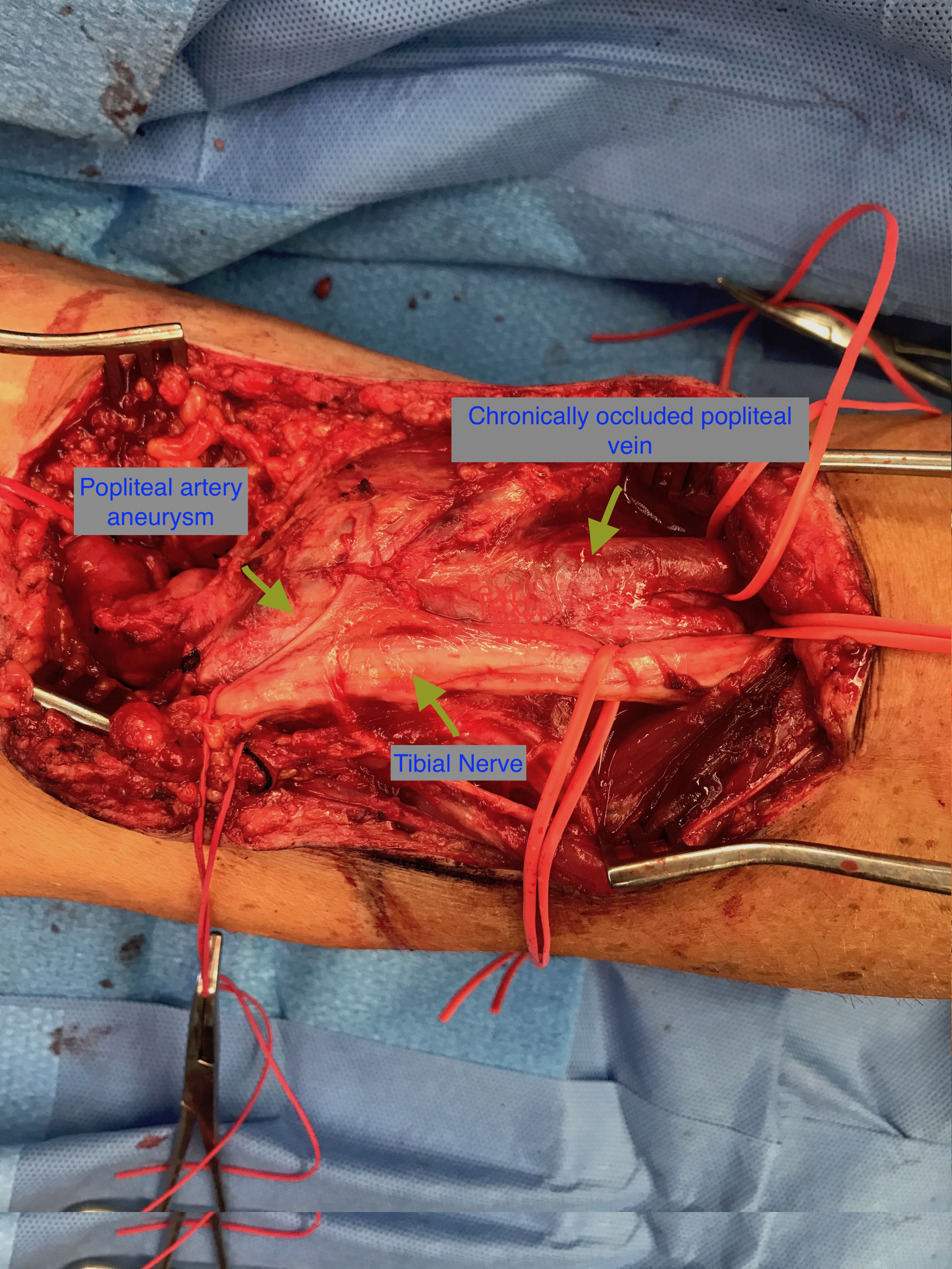 Intra-op popliteal artery aneurysm repair, posterior approach