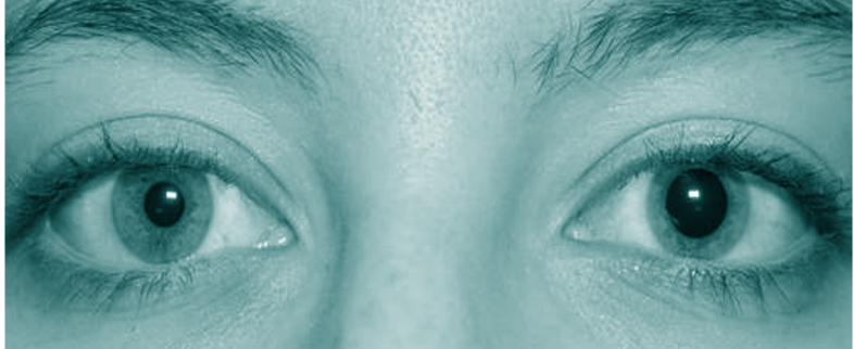 Anisocoria (unequal pupils)