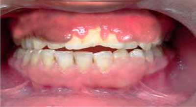 <p>Gingival Overgrowth</p>