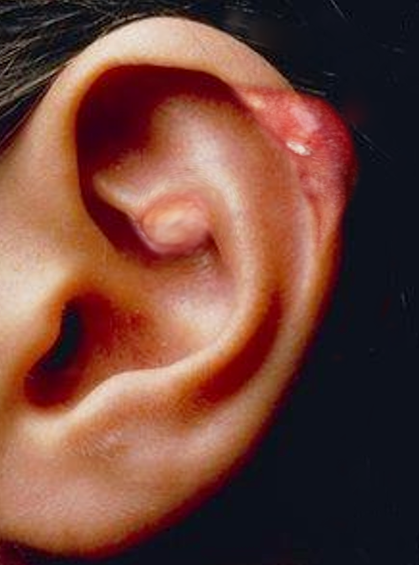 Gout in the Ear