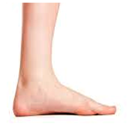 pes planus or flat feet