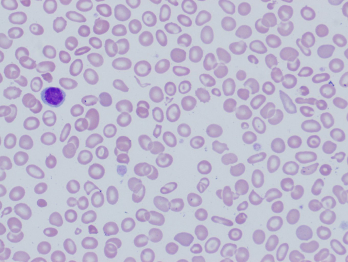 Peripheral blood with features of beta-thalassemia minor. Microcytosis and frequent target cells are characteristic.
