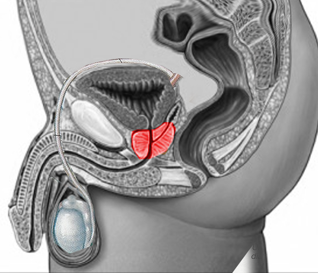 Prostatitis és propolis, Propolisz tinktúra krónikus prosztatagyulladás esetén
