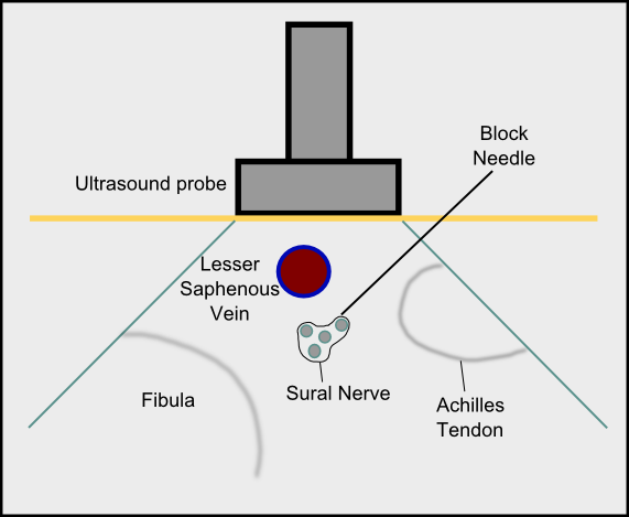 Figure 2. Sural Nerve Block In-Plane Technique
