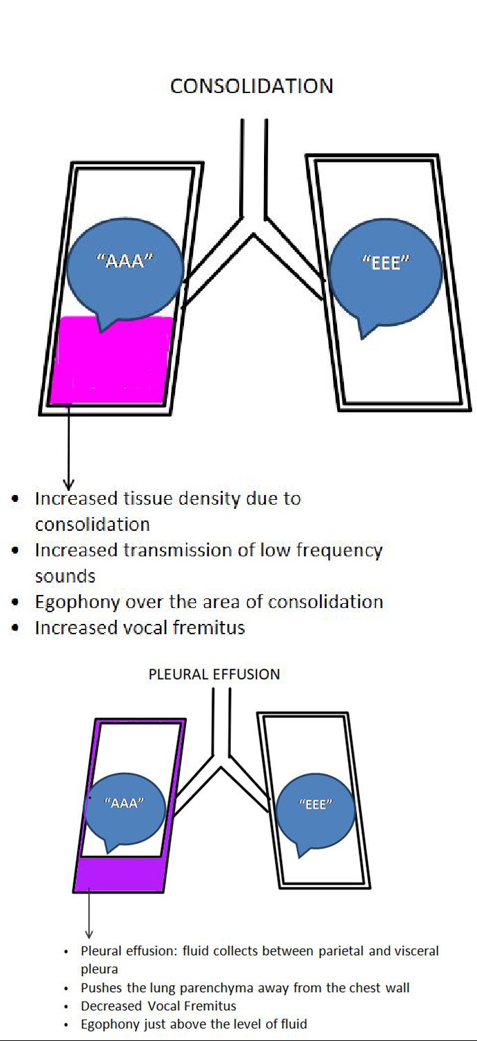 Consolidation and Plueral Effusion