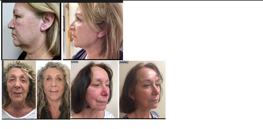 Before and after photos of patients who have undergone the SMAS plication procedure.