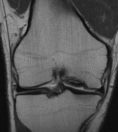 MRI T1 knee - medial femoral condyle Grade 2 osteochondritis dissecans