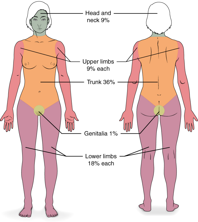 Wallace Rule of Nines for determining percent of burned body surface area.