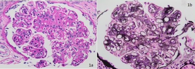 Fig. 1a (PAS x400) and 1b (Jones methenamine silver x400): Hyperlobulated glomeruli showing mesangial and segmental endocapillary hypercellularity, mesangial matrix expansion, and segmental duplication of basement membranes with mesangial cell interposition.  Some peripheral capillary loops appear "wire loop“-like.
