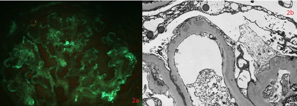 Fig. 1c (FITC x400) Immunofluorescence microscopy showing segmental granular IgG staining.  C3 and C1q showed similar staining.  1d: Ultrastructural examination showing thickened glomerular basement membranes with subendothelial and subepithelial electron-dense deposits consistent with immune complexes within peripheral loops, and diffuse foot process effacement.
