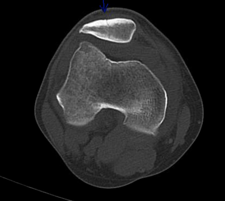 Figure 2: CT scan image of same patient in Figure 1 revealing an incomplete non-displaced fracture in the anterior cortex of 
