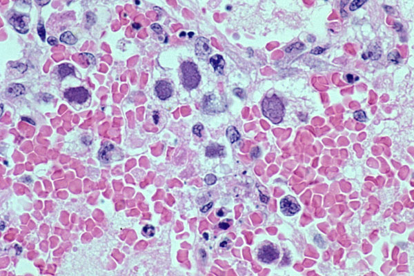 Adenovirus - Smudge Cells
