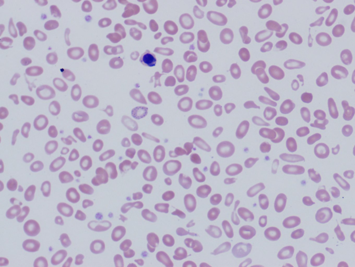 Image 1. Peripheral blood, beta-thalassemia (clinically intermedia) showing anisopoikilocytosis, a nucleated red cell, and basophilic stippling.