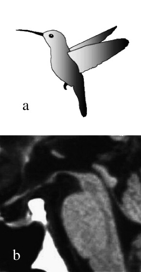 (a) Hummingbird, (b) mid-sagittal plain MRI in PSP. The region including the most rostral midbrain, the midbrain tegmentum, the pontine base, and the cerebellum appears to correspond to the bill, crown, body, and wing, respectively, of a hummingbird (i.e., the “hummingbird sign”)