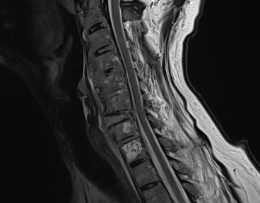 MRI T2 sagittal sequence showing T2 hyperintense lesions of the C7 and T1 vertebral bodies likely representing hemangiomas.