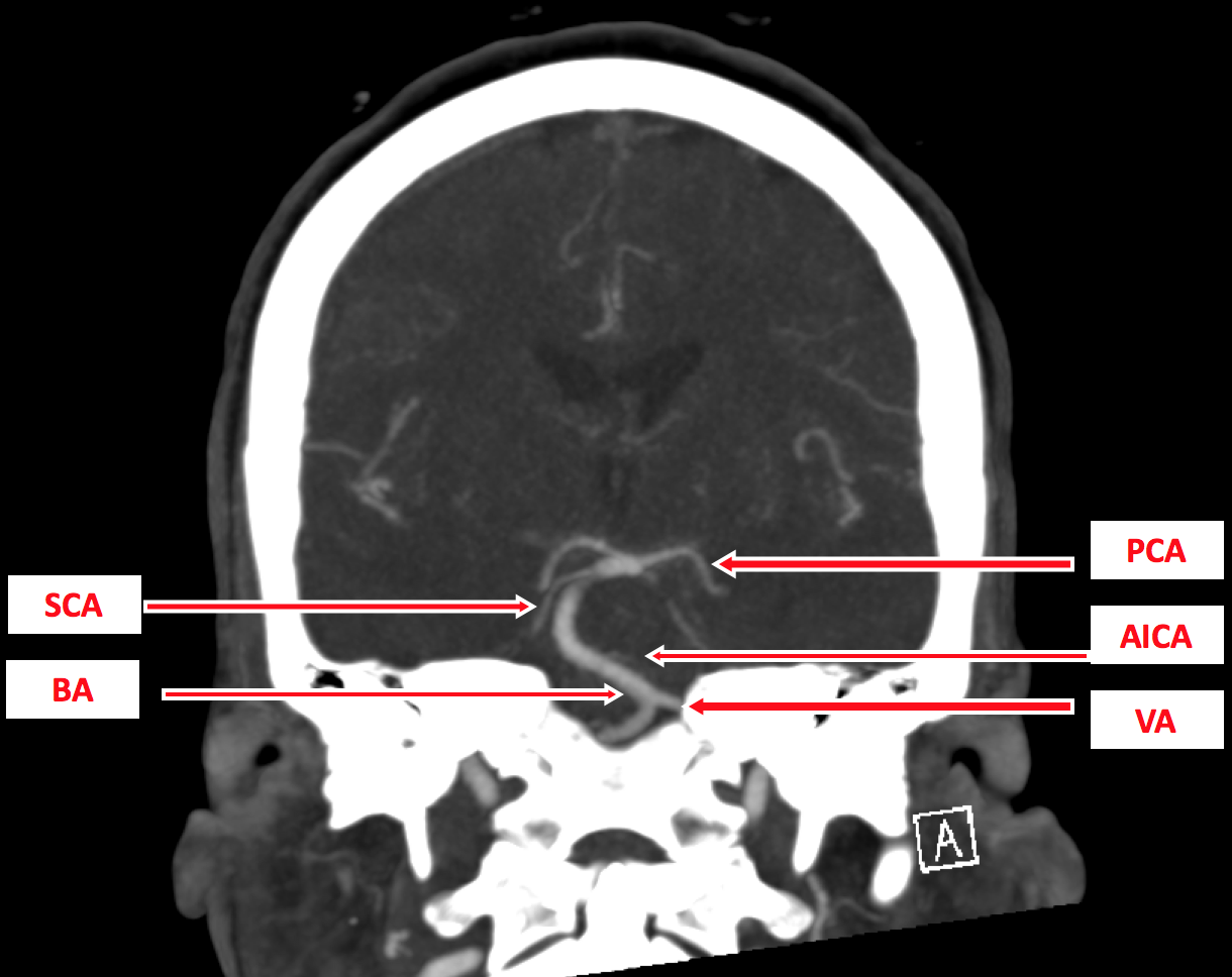 Figure 3 - A coronal section on CTA for posterior circulation: vertebral artery (VA); basilar artery (BA); anterior inferior cerebellar artery (AICA); superior cerebellar artery (SCA); posterior cerebral artery (PCA).