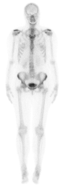 Normal appearance of Technetium 99m MDP bone scan