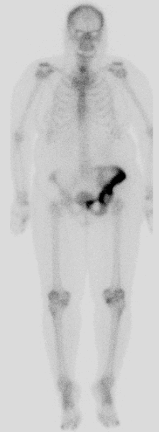 Abnormal uptake in the left hemipelvis on bone scan representing Paget's Disease