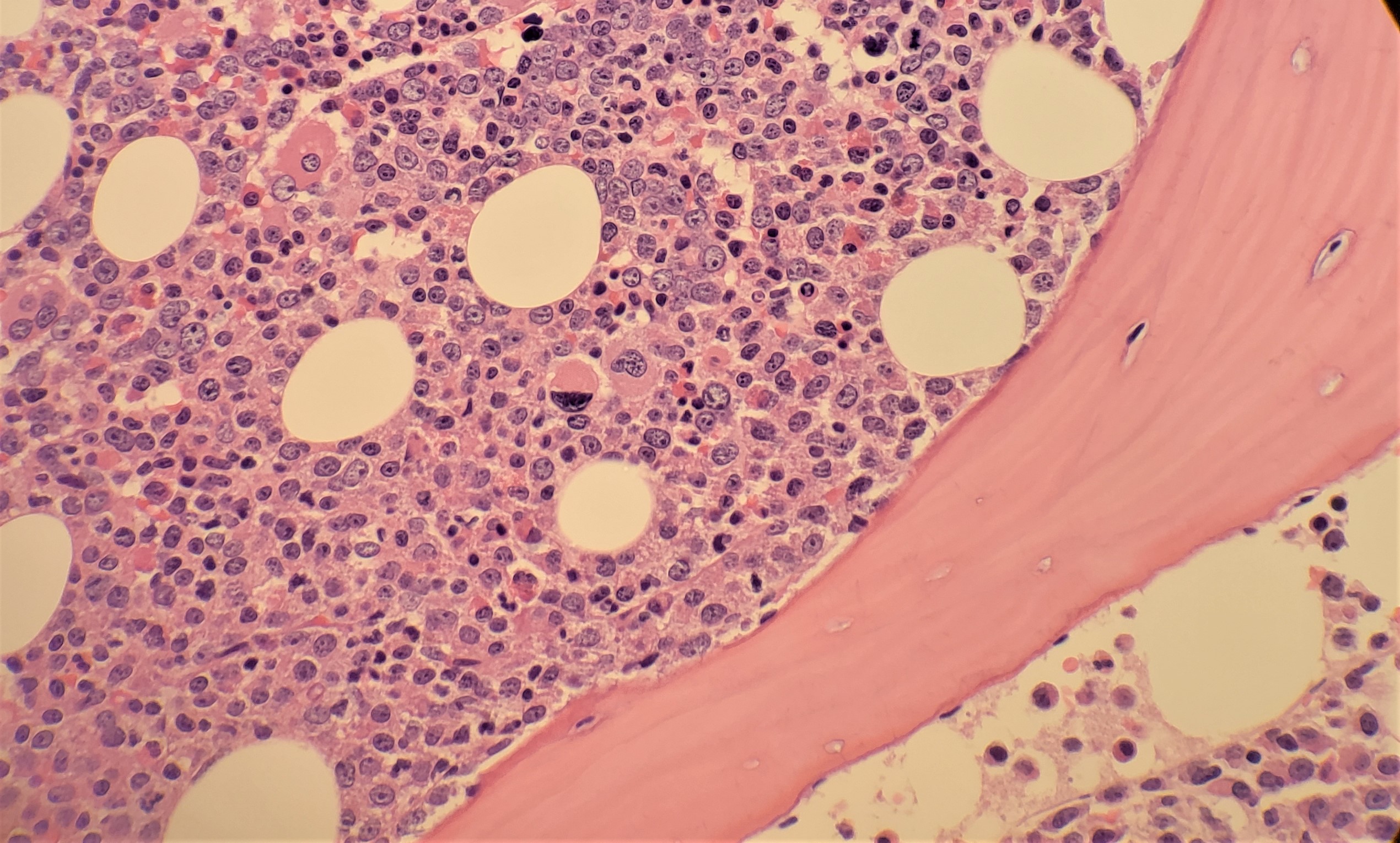 Bone marrow biopsy of Chronic Myeloid Leukemia showing hypercellularity and expansion of immature granulocytic paratrabecular cuff