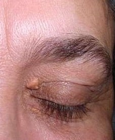 Yellowish deposits over the left upper and lower eyelid