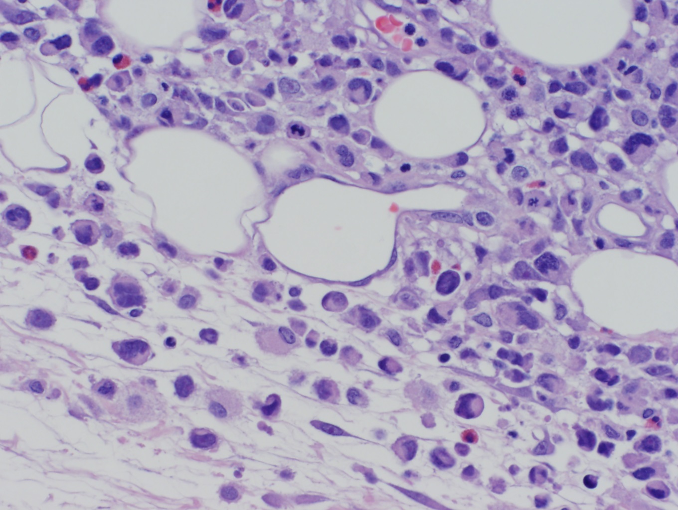 Anaplastic large cell lymphoma