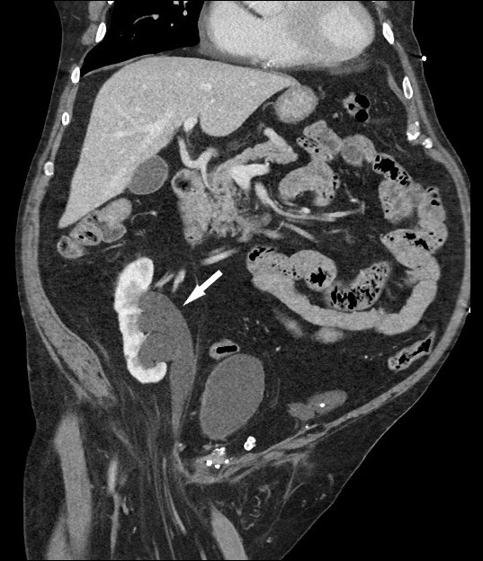 CT of the abdomen and pelvis. Marked hydronephrosis (arrow) of the right kidney can be seen on coronal images, with the right ureter extending caudally with the inguinal hernia.