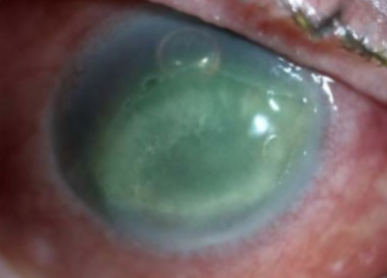 Stage II neurotrophic keratitis. There is loss of epithelium with surrounding loose epithelium which will become smooth and rolled. There is stroll edema and an aqueous flare. 