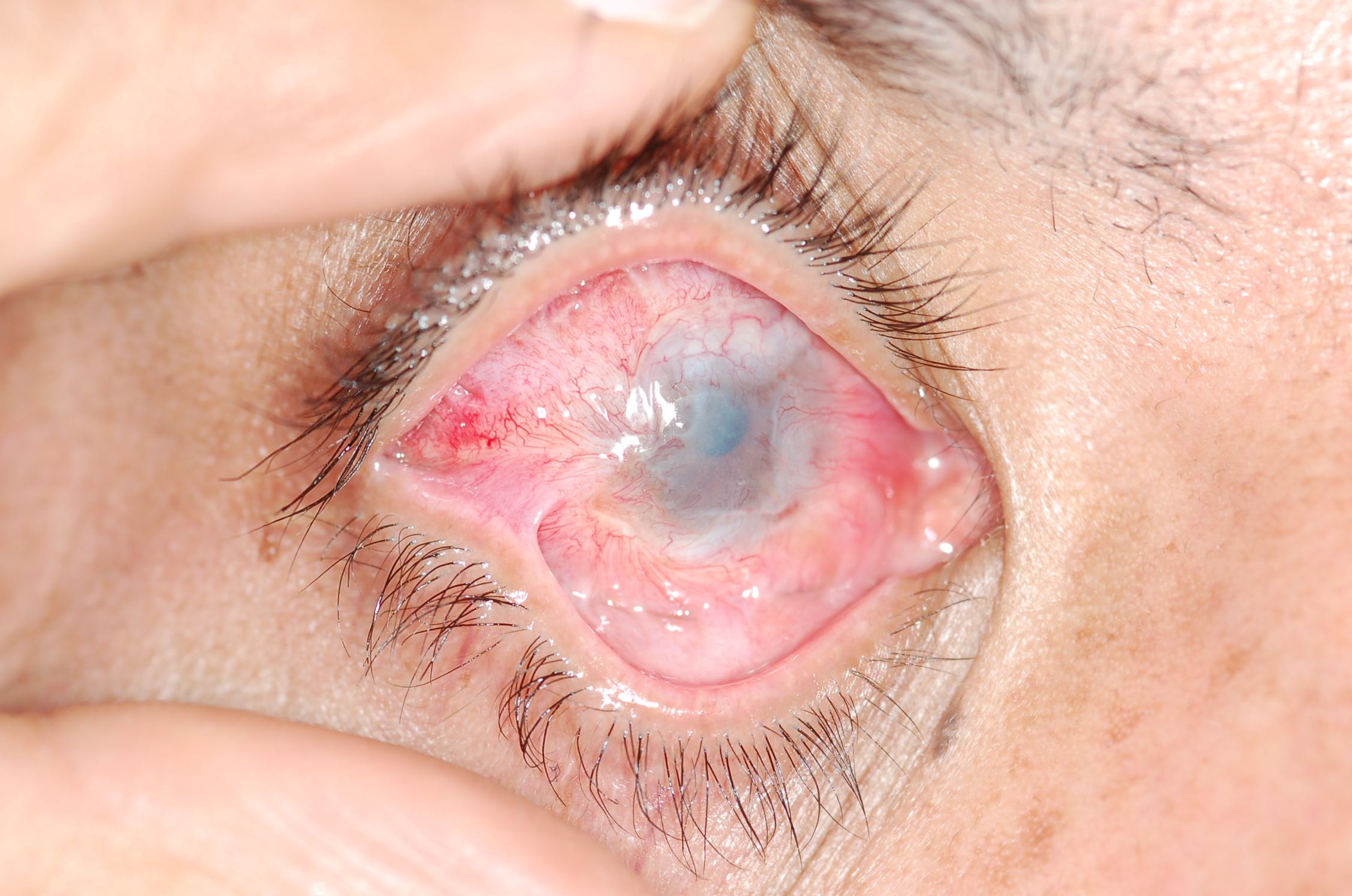 Severe alkali burn to the right eye. Being lipophilic, alkali solutions penetrate the eye more rapidly and have the potential to penetrate ocular tissues.  Acids, on the other hand, cause precipitation of proteins which creates a barrier and prevents further damage in most cases. There is destruction of the limbal stem cells causing limbal stem cell deficiency and opacification and neovasculatization of the cornea. There is symblepharon formation where by there are adhesions between the tarsal and bulbar conjunctiva with loss of the normal fornix. Other complications that can arise are increased intraocular pressure from inflammatory changes and direct damage to the trabecular meshwork. Loss of goblet cells and scarring of the lacrimal ductules exacerbates dryness. 