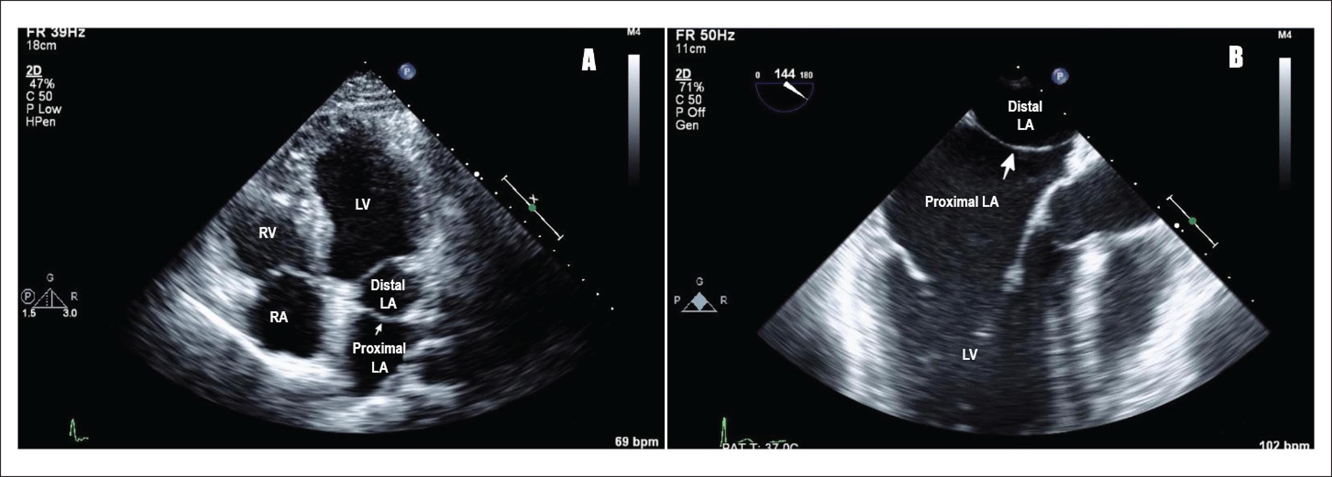 Figure 1 A) Transthoracic echocardiogram showing cor triatriatum: proximal and distal left atrium separated by a membrane (Pointing white arrow), LA: left atrium; LV: left ventricle; RV: right ventricle; RA: right atrium. B) Transesophageal echocardiogram showing cor triatriatum: proximal and distal left atrium separated by a membrane (Pointing white arrow), LA: left atrium; LV: left ventricle. 