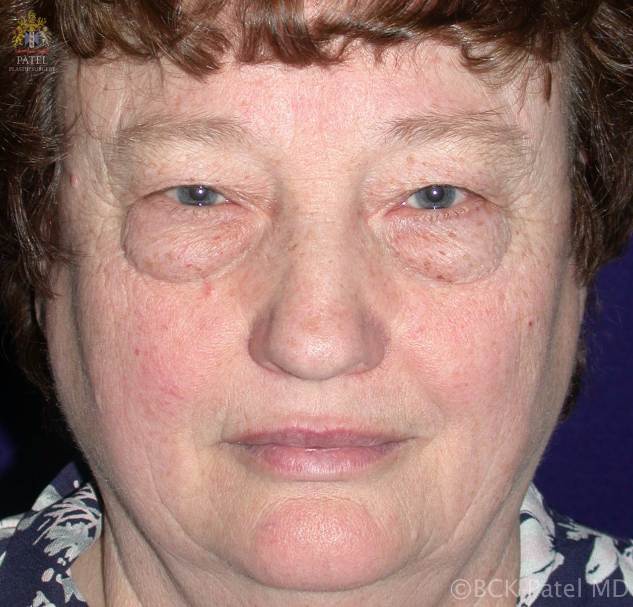 A 56-year-old female seeks lower eyelid blepharoplasty. 